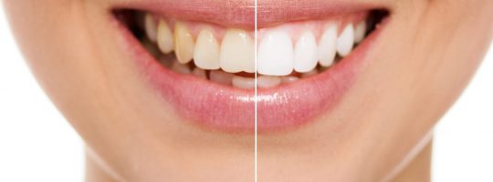 Clareamento dental: tire suas dúvidas sobre o procedimento